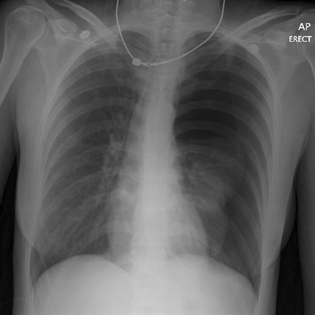tension pneumothroax