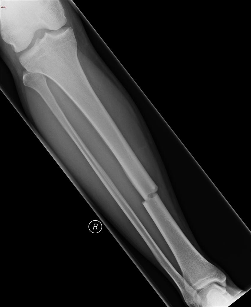 tibial midshaft
