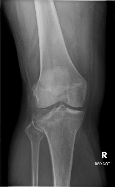 tibial plateau