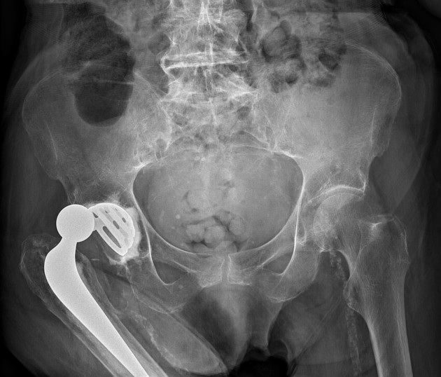 total hip replacement