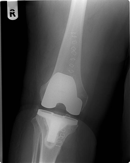 total knee arthroplasty