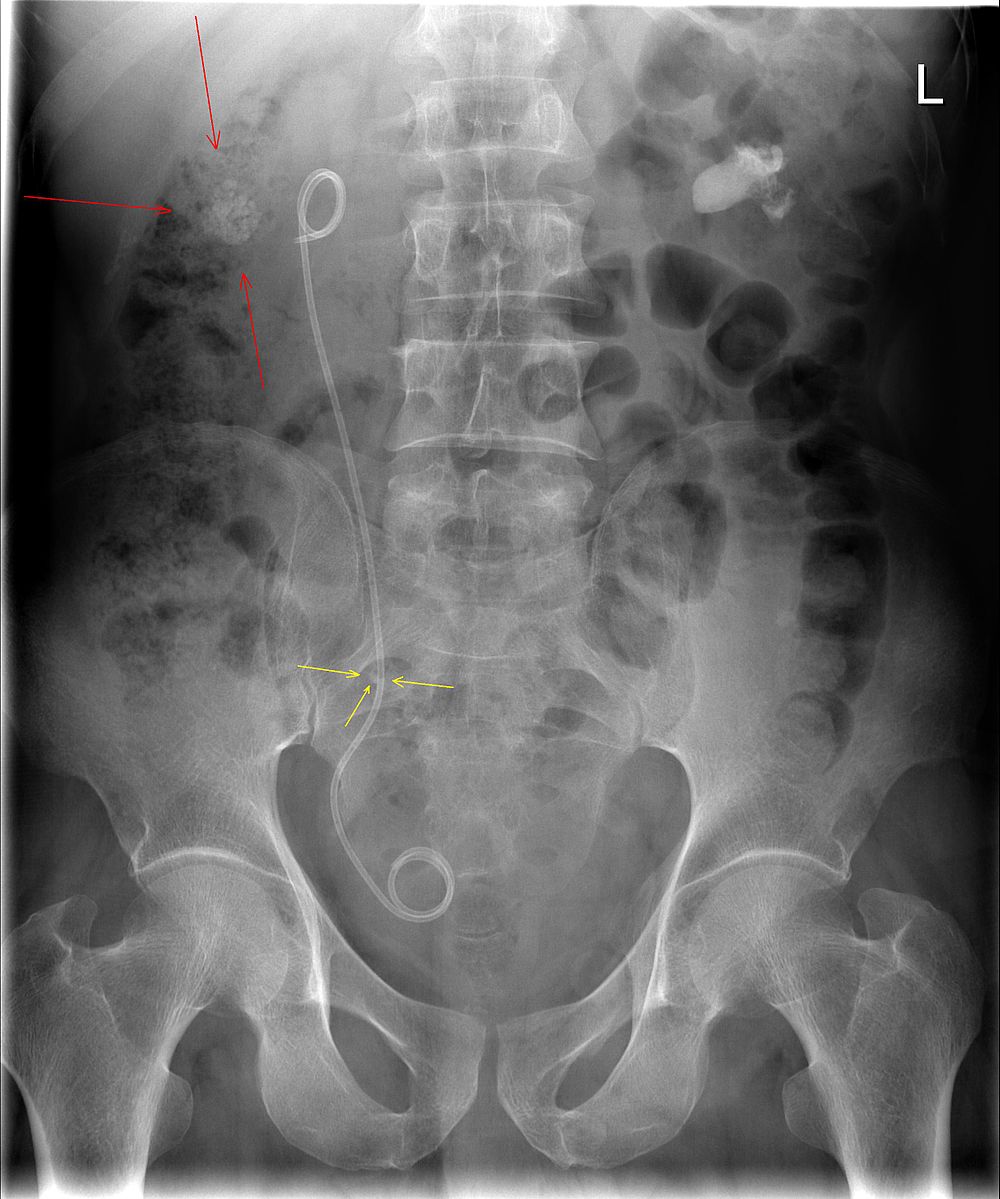 ureteric stent