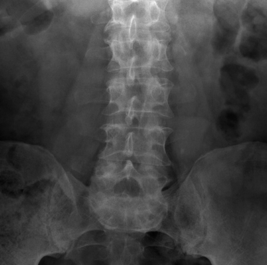 ureteric stones