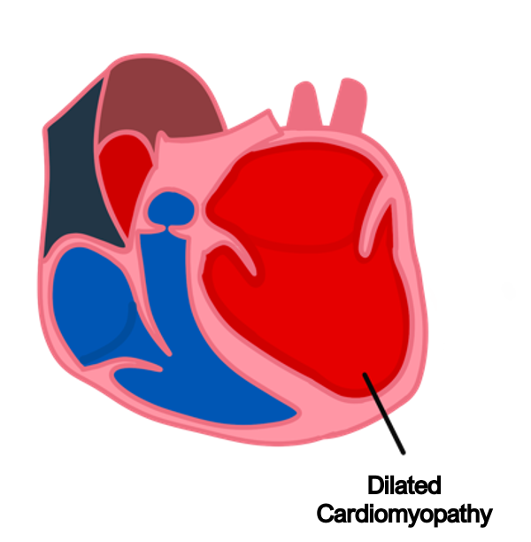 Screenshot 2023-06-11 at 17.06.05 dilated cardiomyopathy