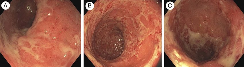 Sigmoidoscopy-findings-of-active-ulcerative-colitis-show-marked-erythematous-mucosa-lack
