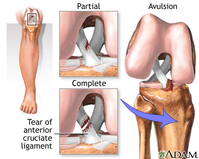 ACL injury